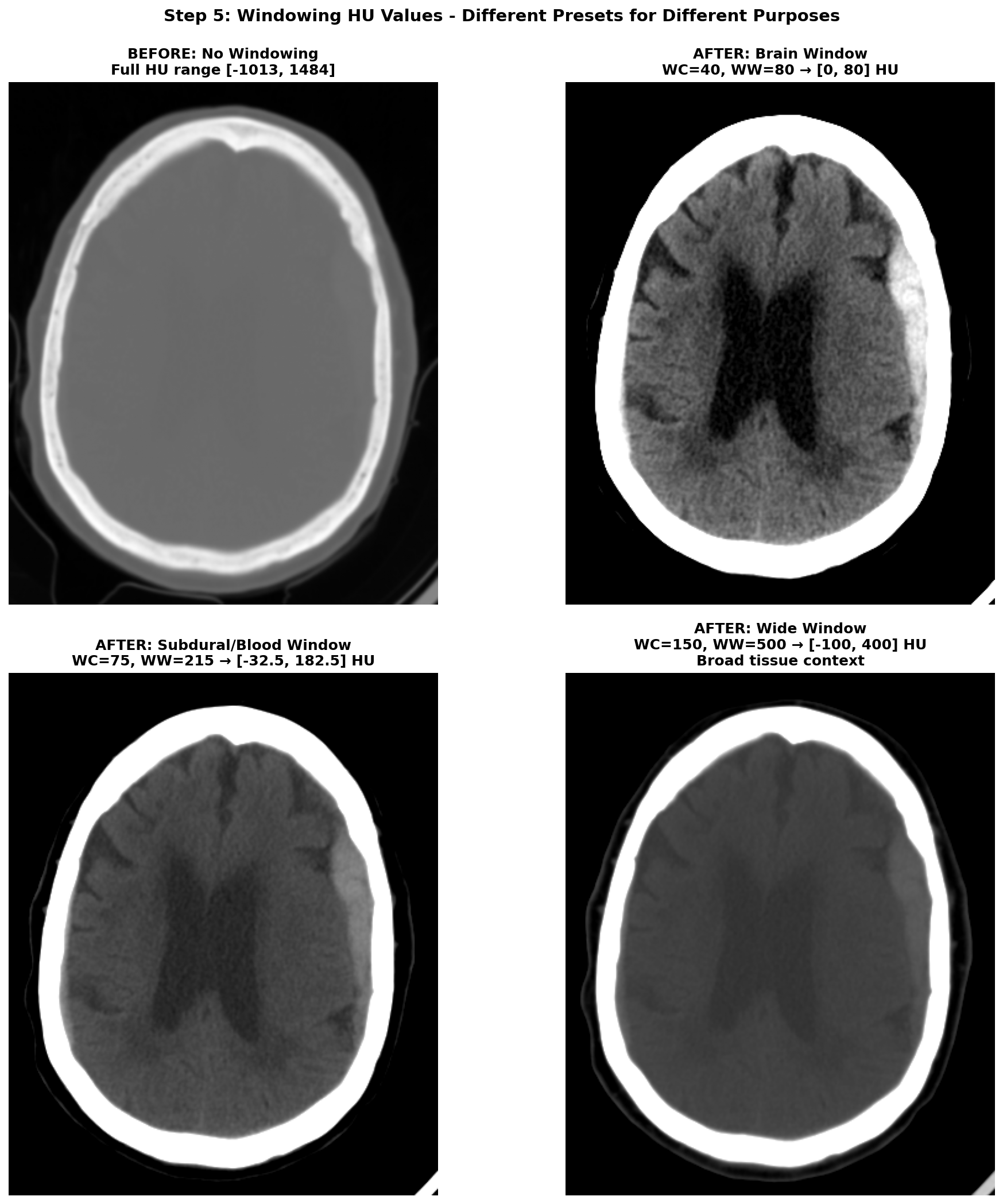 Effect of windowing on CT visualization